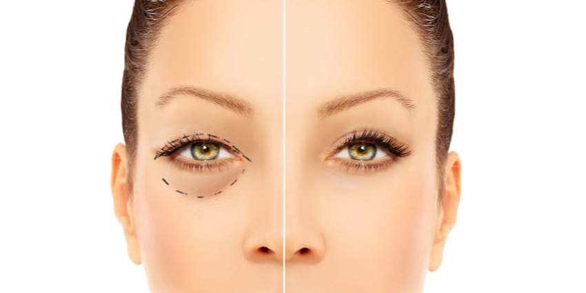 برای انتخاب جراح بلفاروپلاستی به چه نکاتی توجه کنیم؟