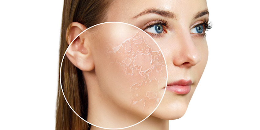 چرا پوست دهیدراته میشود؟